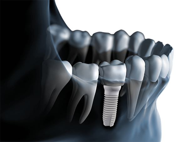 Z-SYSTEMS Implants